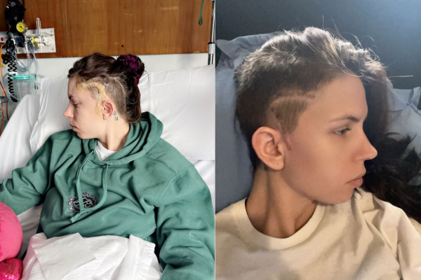 Jammie-Lee scars post epilepsy surgery at Austin Health